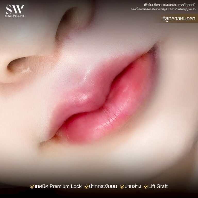 lip-sergery1