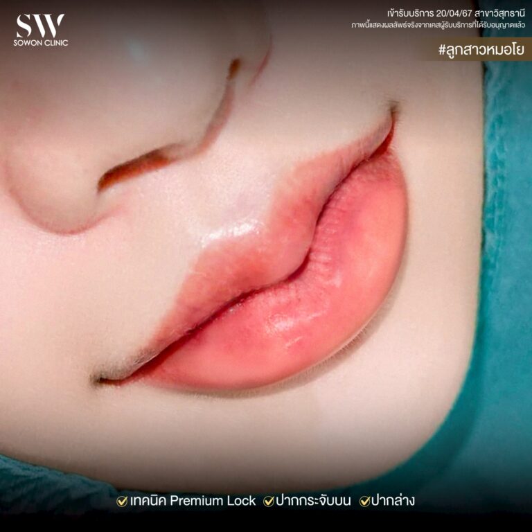 lip-sergery2