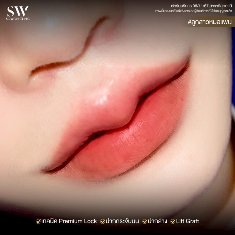 lip-sergery5