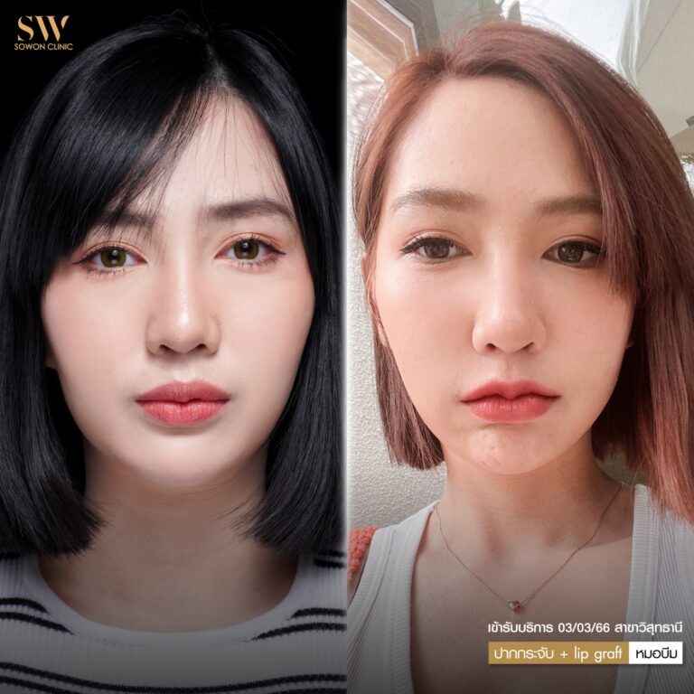 promotion-lip-surgery-ads-lip4432
