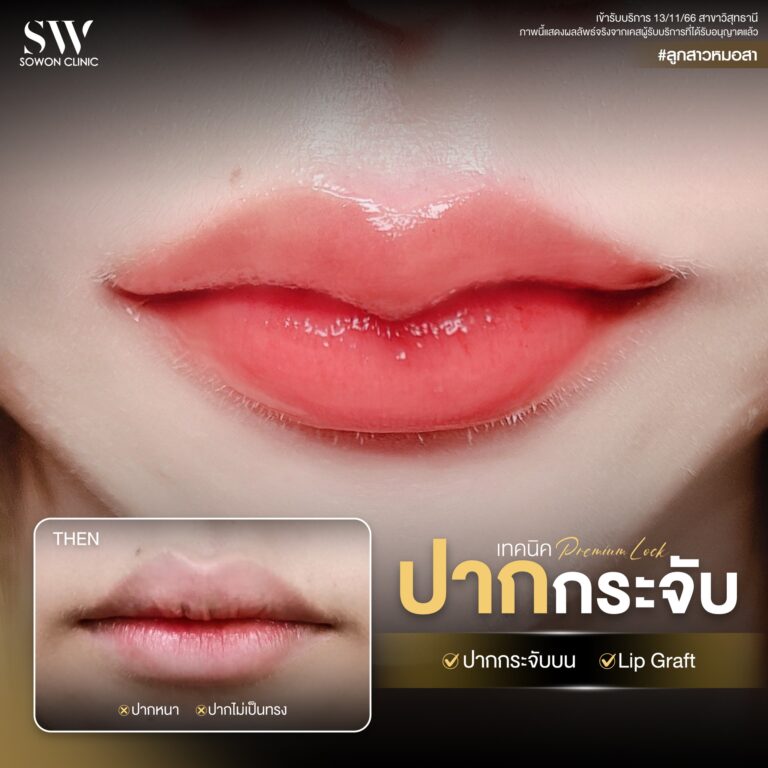 promotion-lip-surgery-ads-lip5