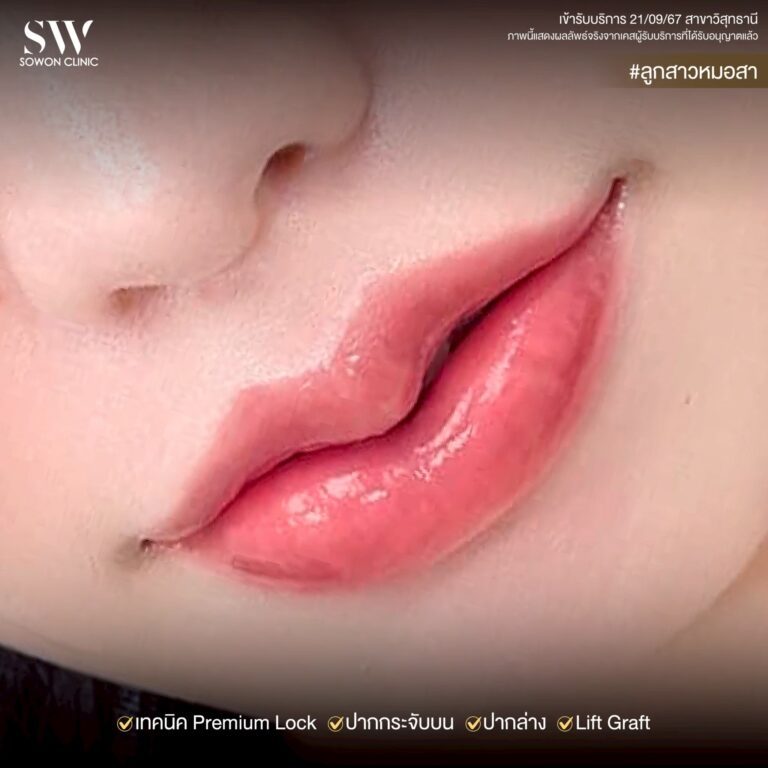 promotion-lip-surgery-ads-lip554