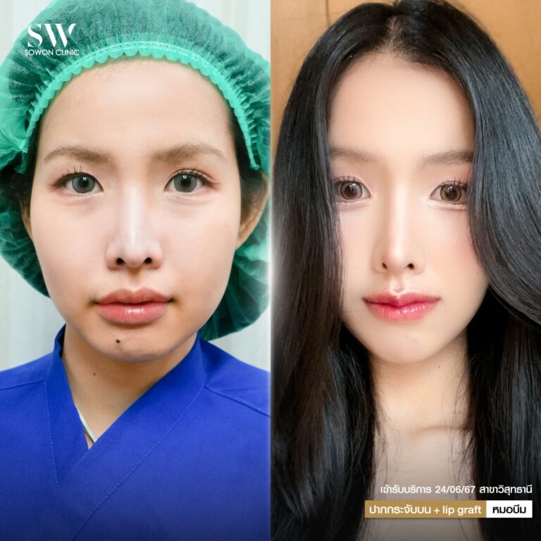 promotion-lip-surgery-ads-lip55t