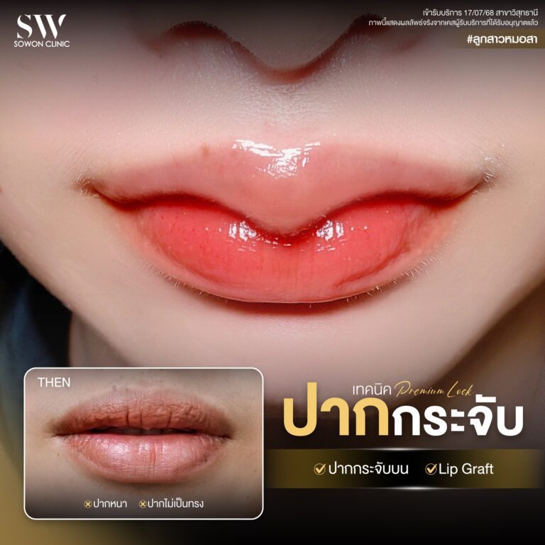 promotion-lip-surgery-ads-lip7