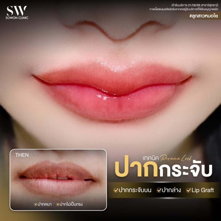 promotion-lip-surgery-ads-lip8
