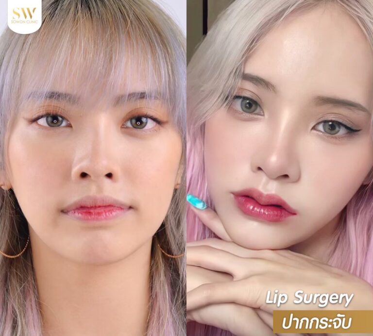promotion-lip-surgery-ads-lipdsad