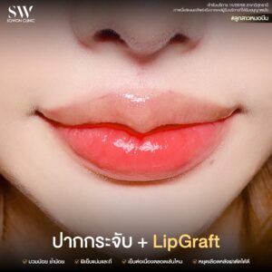 promotion-lip-surgery-ads-liper