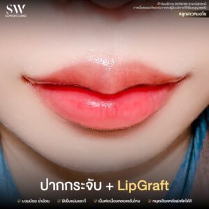 promotion-lip-surgery-ads-liprr