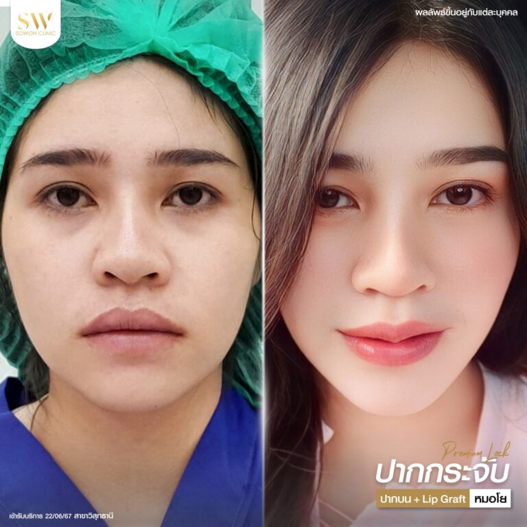 promotion-lip-surgery-ads-lipsdsad