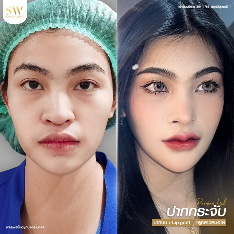promotion-lip-surgery-ads-lipssad