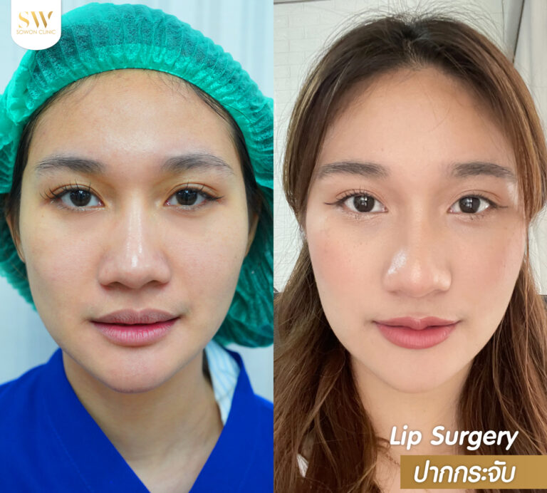promotion-lip-surgery-ads-lipssd