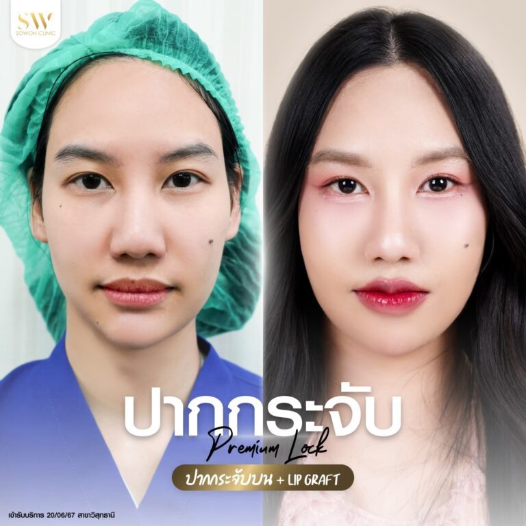 promotion-lip-surgery-ads-lipssdd