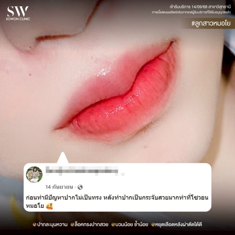 promotion-lip-surgery-ads-lipuui