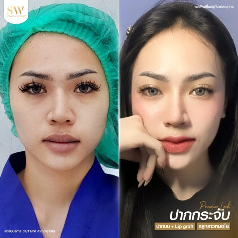 promotion-lip-surgery-ads-lipuuy